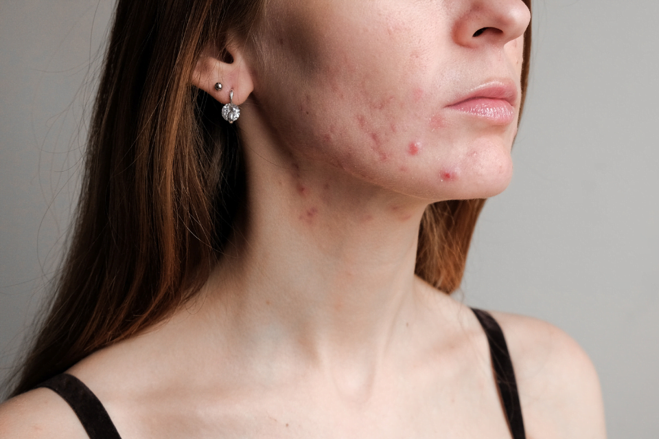 acne