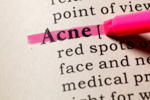 acne
