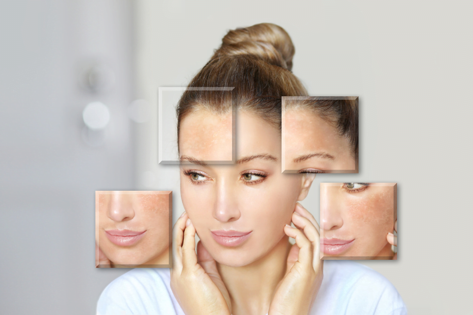 Iperpigmentazioni cutanee: come combattere e prevenire le macchie della pelle 8 iperpigmentazioni cutanee