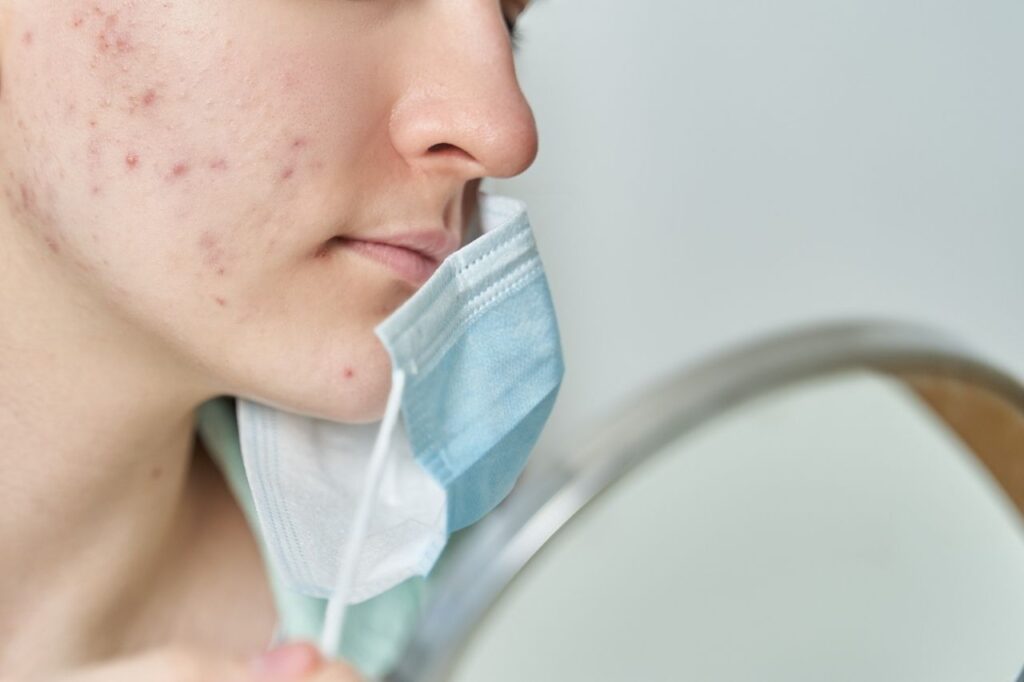 Acne da mascherina: la Maskne, cosa è, cause, sintomi e rimedi 10 maskne