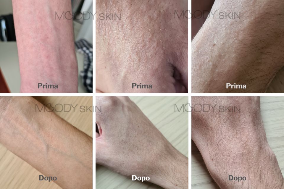 risultato finale post dermatite atopica