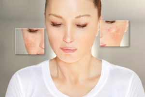 rosacea