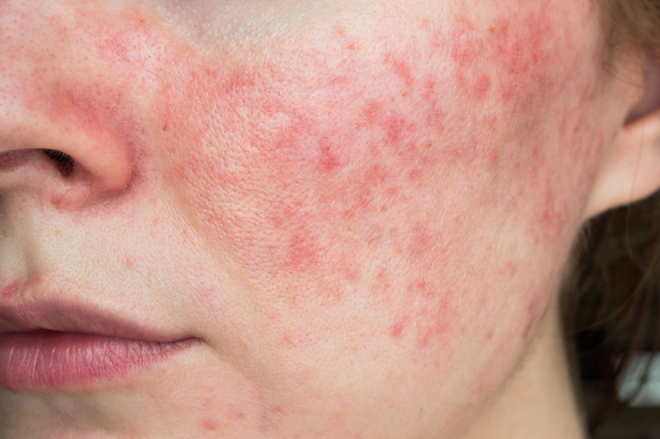 Rosacea: cos’è e quali cosmetici utilizzare 2 rosacea
