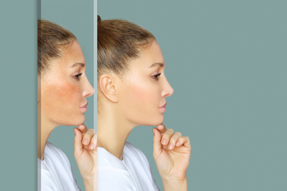 Rosacea: cos’è e quali cosmetici utilizzare 3 rosacea