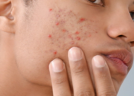 acne | Skincare per acne