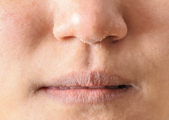 disidratazione | Skincare per pelle disidratata