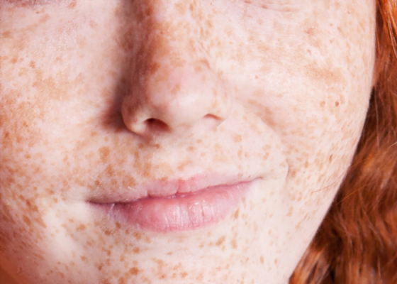 macchie | skincare per macchie