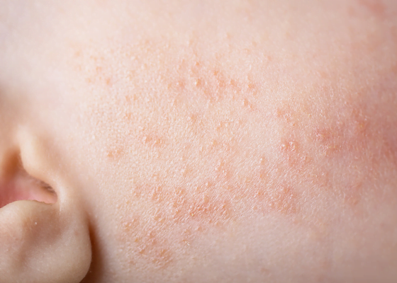 pelle atopica | Skincare per pelle atopica