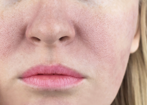 pori dilatati | skincare per pori dilatati