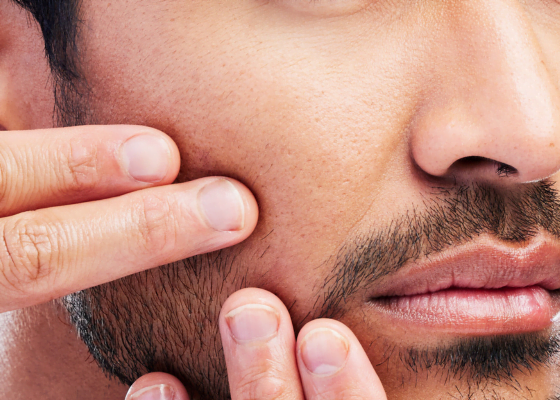 punti neri | skincare per punti neri