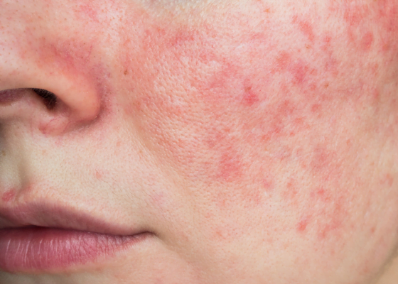 rosacea | Skincare per rosacea