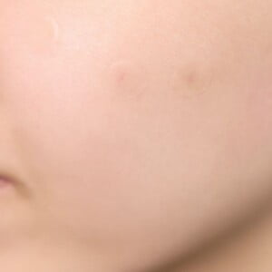 SKIN1004 Spot Cover Patch 22pcs - Cerotti per brufoli