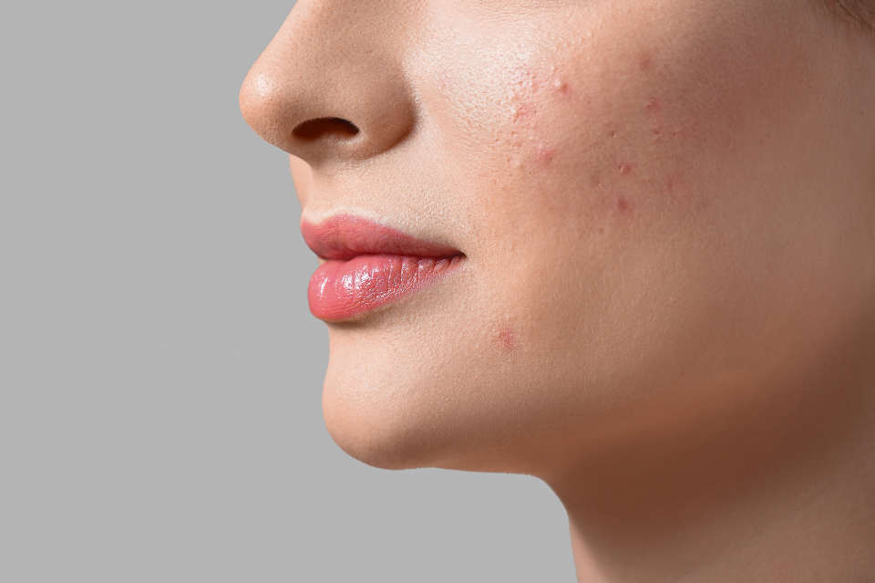 Acido azelaico nei cosmetici 3 acido azelaico