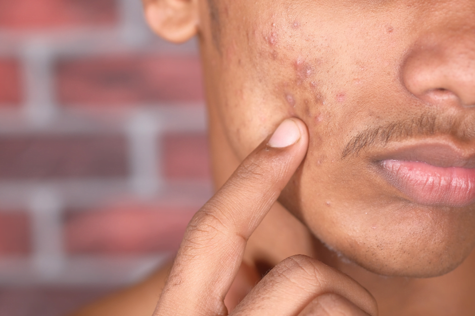 Acido azelaico nei cosmetici 2 acido azelaico