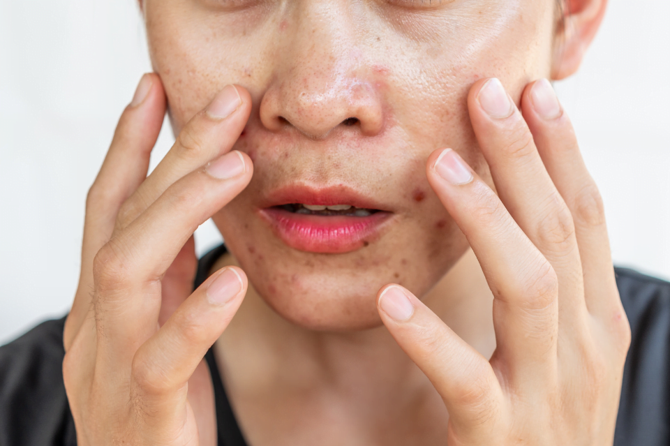 Acido azelaico nei cosmetici 5 acido azelaico