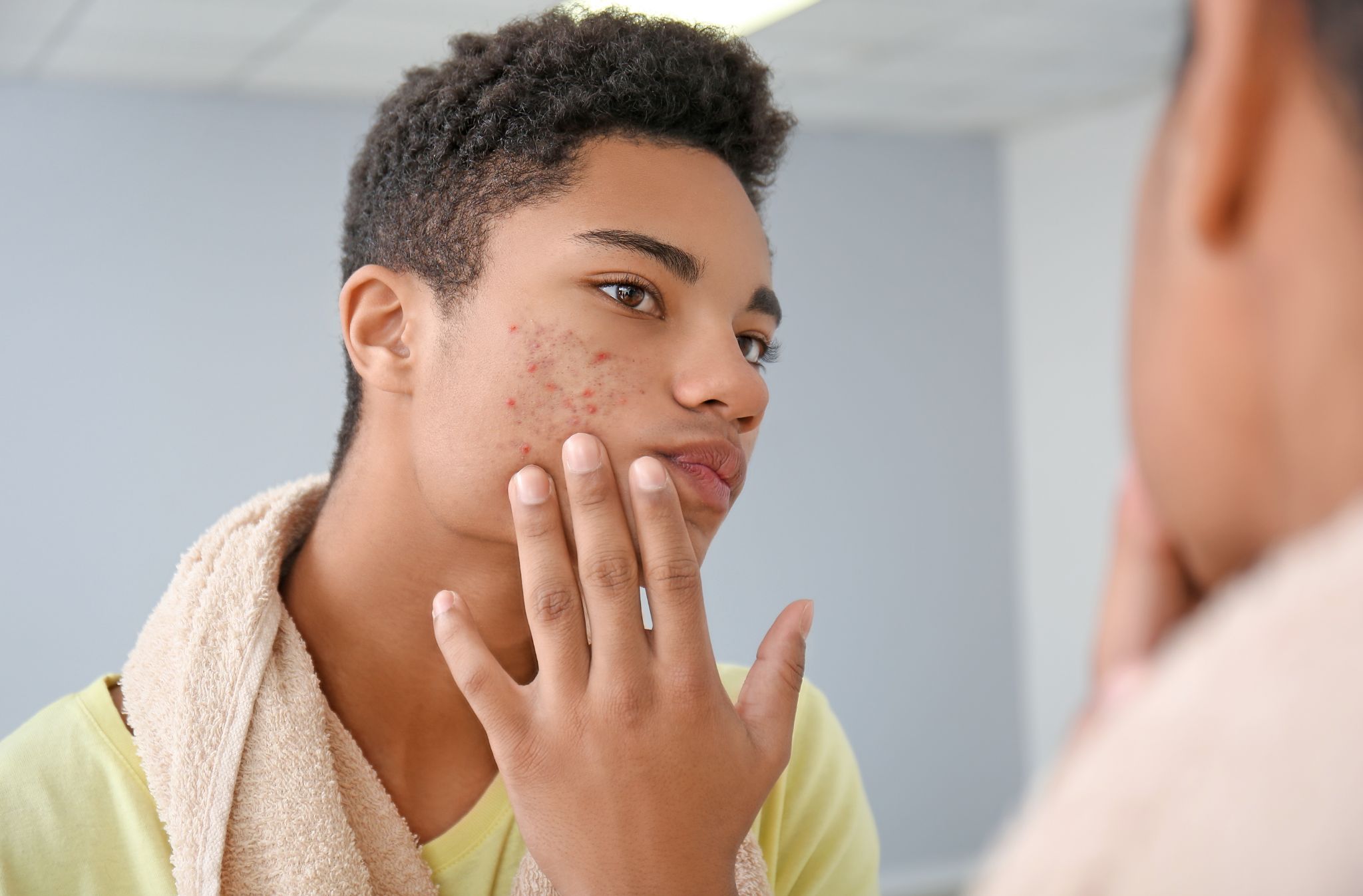 skincare acne 1