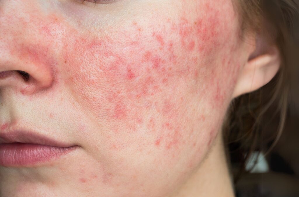 skincare rosacea