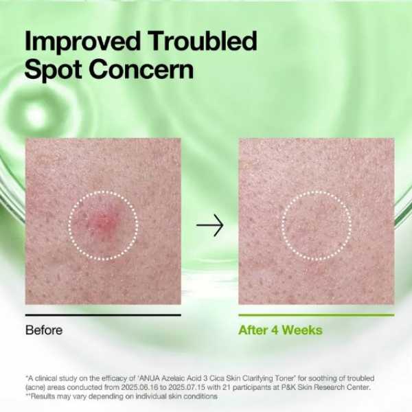ANUA Azelaic Acid 3 Cica Skin Clarifying Toner 250ml 4 ANUA Azelaic Acid 3 Cica Skin Clarifying Toner benefits 3